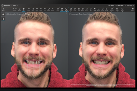 New Software Introduction: Invisalign Smile ArchitectTM